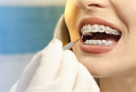 How Magic Teeth Braces Can Improve Your Oral Health
